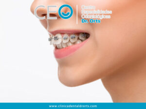 Mitos Sobre Los Brackets