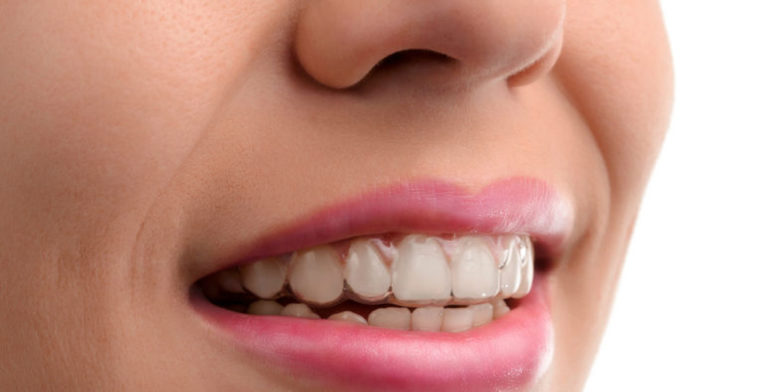 Tu Mejor Sonrisa: Invisalign