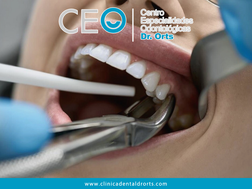 La Extracción Dental